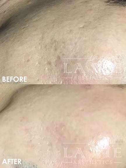 MRF (RF Microneedling) Promotion